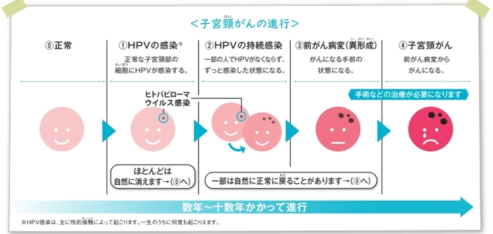 子宮頸がんの進行のイメージ
